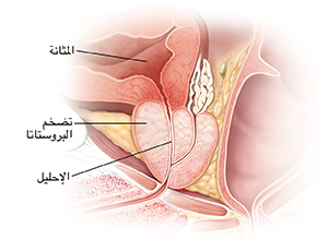 مقطع عرضي لغدة بروستاتا متضخمة.