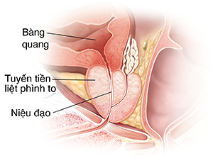 Mặt cắt ngang của tuyến tiền liệt phì đại.