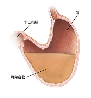 胃和十二指腸的剖面圖。胃大且下垂。下垂部分胃的內容物不能正常從胃移出至十二指腸。