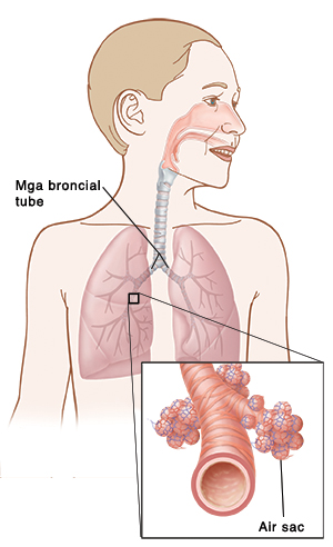 Ilustrasyon na nagpapakita ng posisyon ng mga baga at mga bronchial na tubo, na may malapitang tanaw ng isang bulsa ng hangin (air sac).