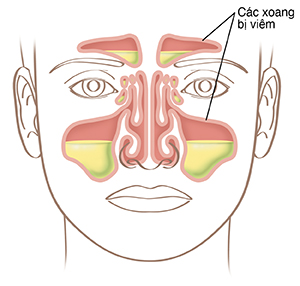 Hình minh hoạ một khuôn mặt cho thấy các xoang mũi bị sưng.